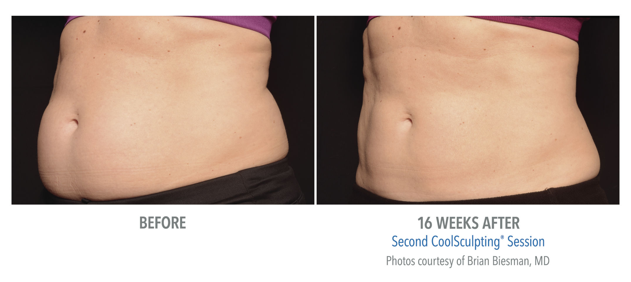 CoolSculpting targets, freezes stubborn body fat 4